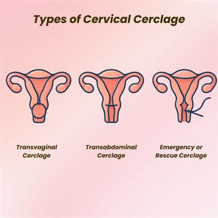 Does a cerclage work with twins?