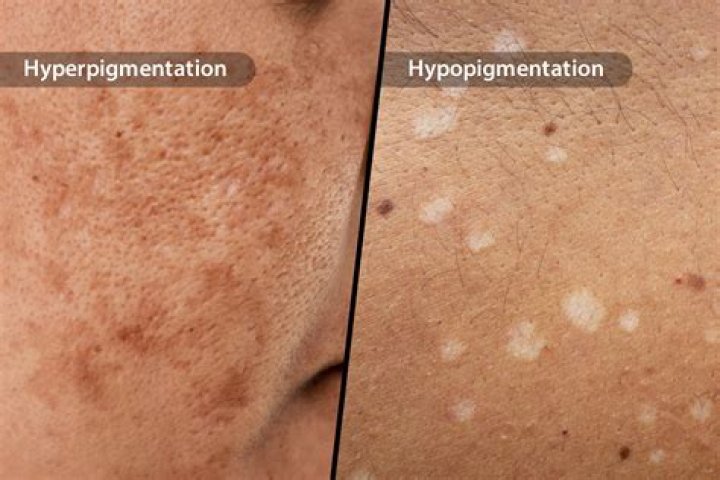 How is hypopigmentation treated after laser?