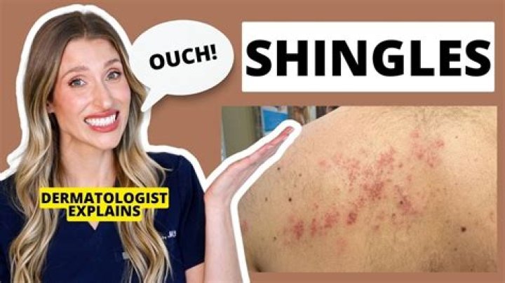 Is it OK to be around someone with shingles?