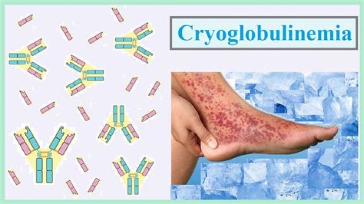 What does cryoglobulinemia look like?