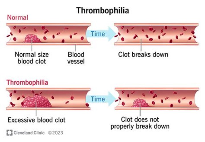 When should a thrombophilia screen be done?